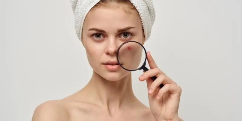 cac-vi-tri-cua-mun-moc-noi-len-dieu-gi