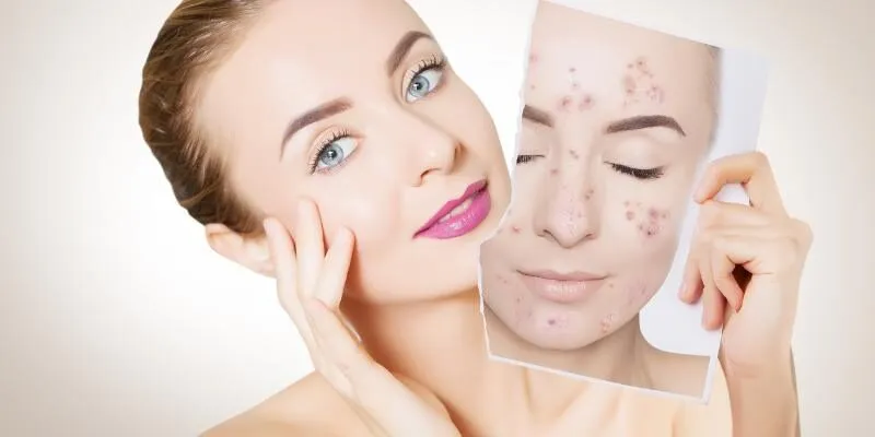 tips-cham-soc-da-ngan-ngua-mun-trung-ca