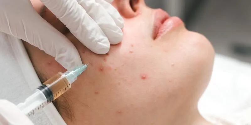 dieu-tri-mun-khong-seo-medi-acne