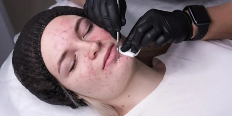 dieu-tri-mun-khong-seo-medi-acne