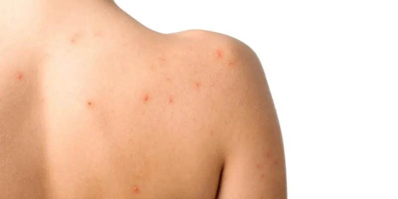 dieu-tri-mun-lung-back-acne