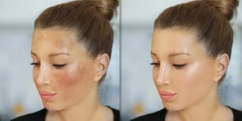 dieu-tri-nam-tan-nhang-cong-nghe-melas-cell